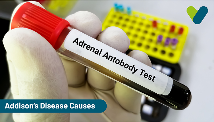 Addison’s Disease Causes: Understand Adrenal Insufficiency Causes In ...